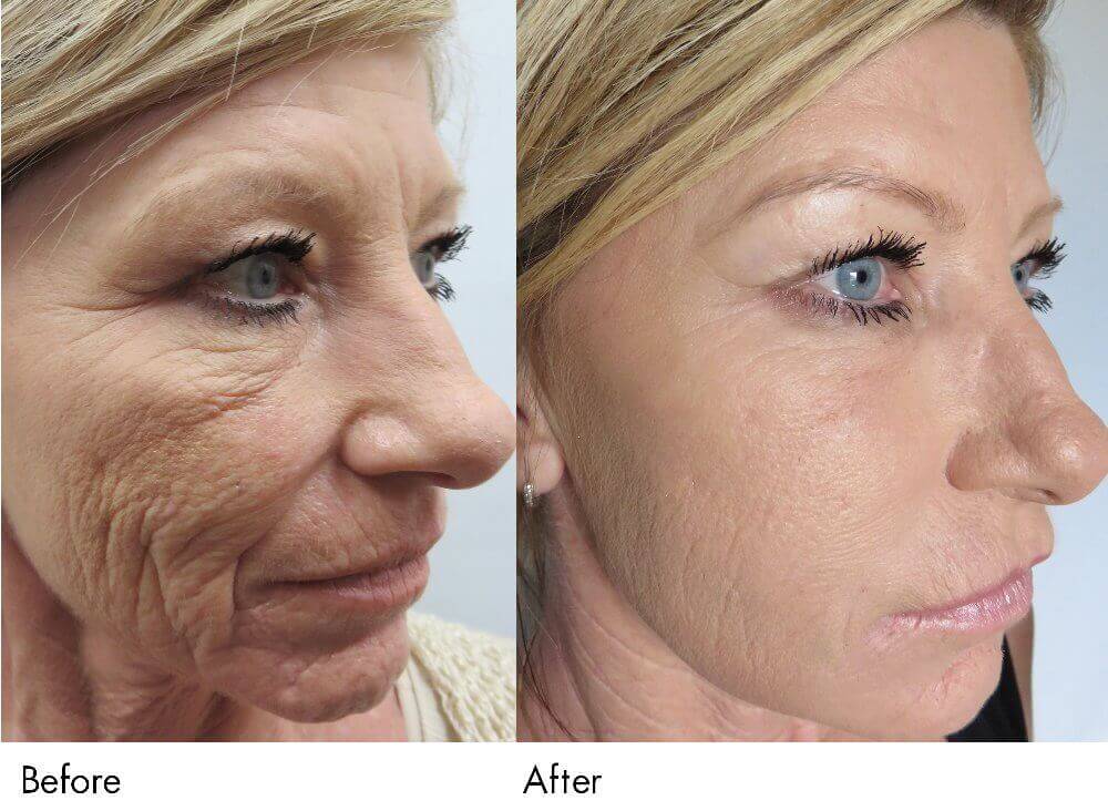 dermaroller-before-and-after-for-wrinkles